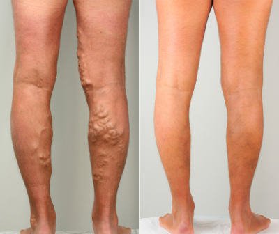 Varicoză sub nivelul genunchiului - Care sunt squaturile periculoase în varicoza